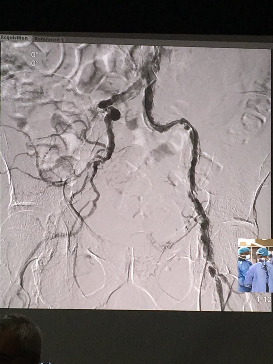PeckyDeSilva's tweet photo. Love the fact that the peripheral arterial workshop decided to start with a very difficult case! #ASVS17 #notgoingtobebored #goodluck https://t.co/kLstKl17A2