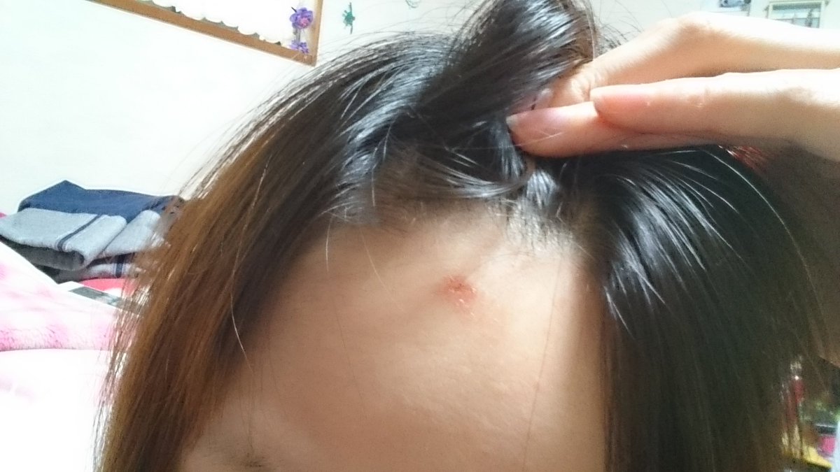 みほがが Live6月13日 日 だよっ Auf Twitter 前髪アイロンかけたら おでこ火傷しちゃって数日ほっといたらかさぶたぶたぶ出来たっ 笑 さぁ 仕事いくかっ