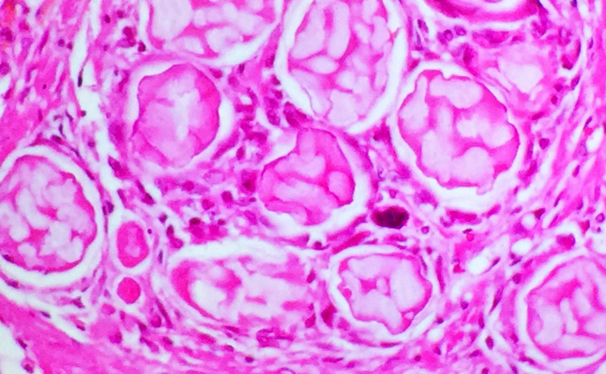 Sara_Jiang's tweet photo. Dr. Roggli's pathology potpourri today @DukePathDept GR! What are these, and what is the significance of finding these in the lung? #PulmPath @Tiger_Path @TAsporn1 #mysterycase https://t.co/bY9oDVRy60
