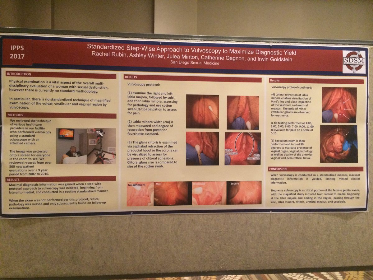 drrachelrubin's tweet photo. Check out our research at #IPPS17 #vestibulodynia #vulvoscopy #vestibulectomy @SDSexualMed @JamesASimonMD https://t.co/z6mq5nWhGY