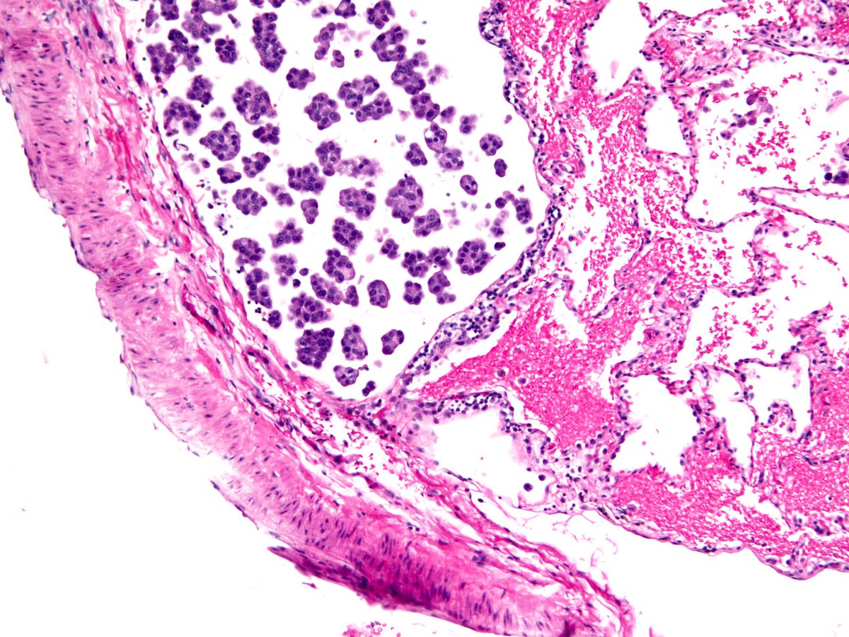 smlungpathguy's tweet photo. A bad thing to find in a lymphatic. Lung adenocarcinoma in a micropapillary pattern 

#pulmpath #pathology #lungcancer https://t.co/QNnizhdxqX