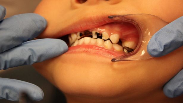 JillOmbrello's tweet photo. Severe tooth decay continues to land thousands in the hospital. This is terrible! https://t.co/ifpHryPHSA #oralhygiene #dentalissues https://t.co/CVjhTSytsB