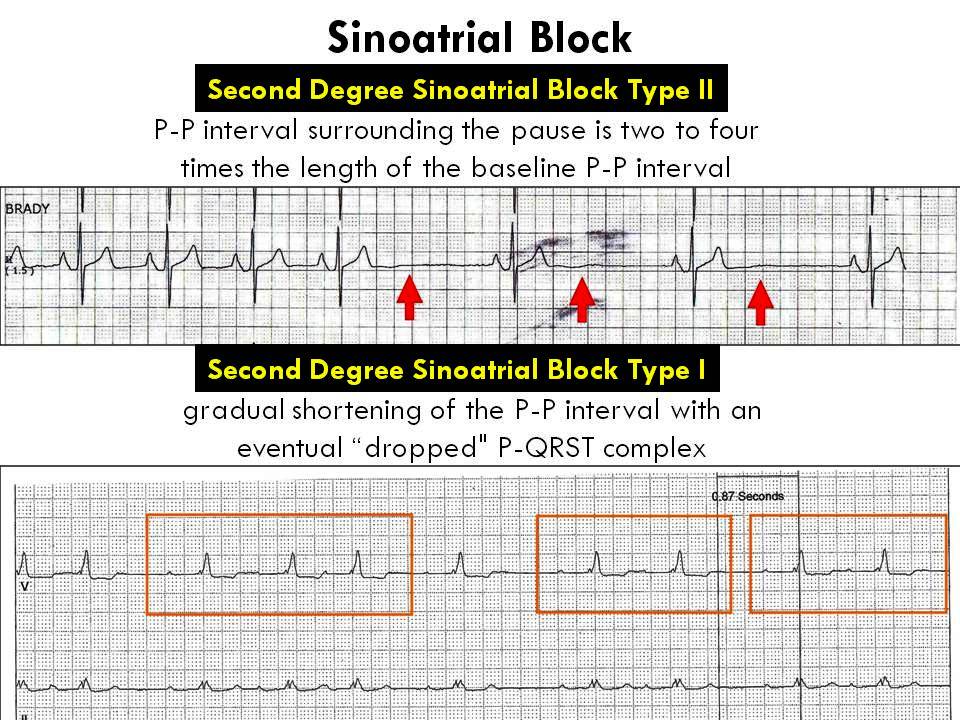 ホイスト にもかかわらず アレルギー 心電図 sa ブロック 推測する その後 評決