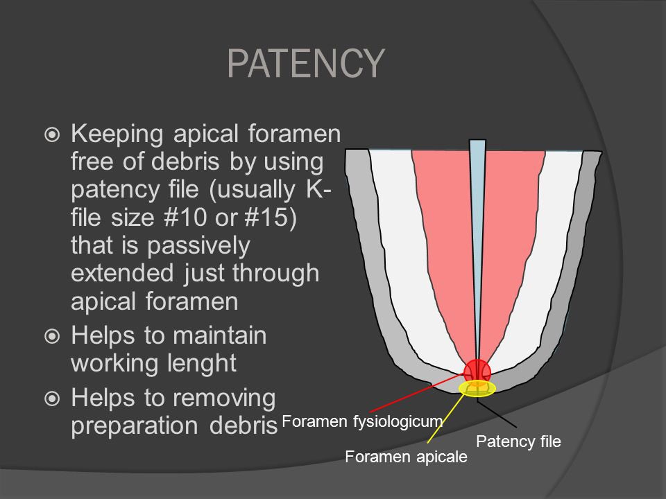 Yara Ebrahim on Twitter: "What is apical patency #endodontics…