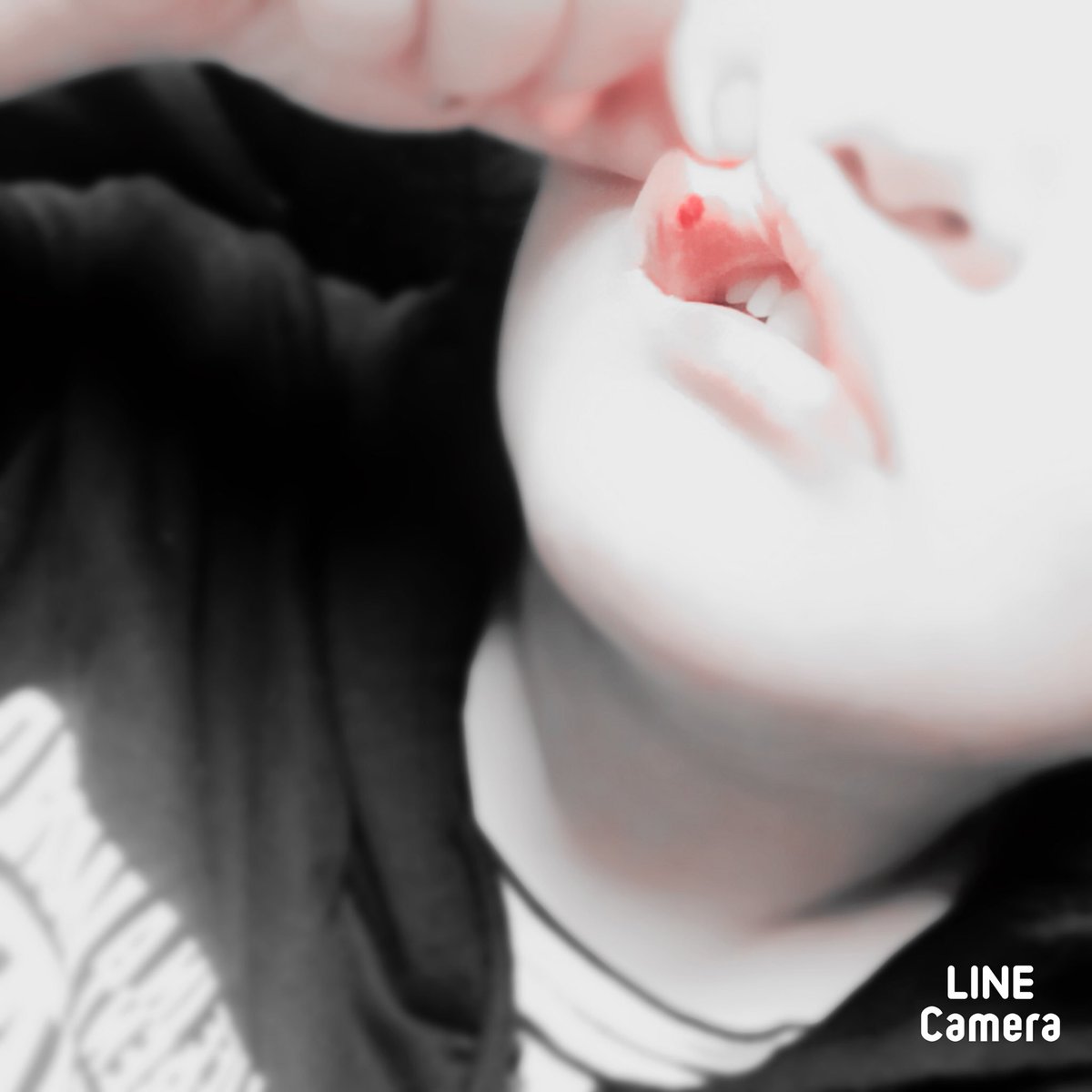 たけち グロ注意 閲覧注意 悲報 食事中唇を噛んでしまい内出血 口内炎みたいに沁みたりは一切ないけれど腫れ てます 押しても痛くはないです