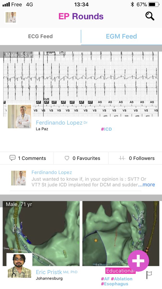 sozi81's tweet photo. Now live on #Eprounds : esophagus damage just with cs engagement. Possible!? And nice tracings from #ICD and #SJM device. #SVT or #VT ? https://t.co/w99Spwep6r