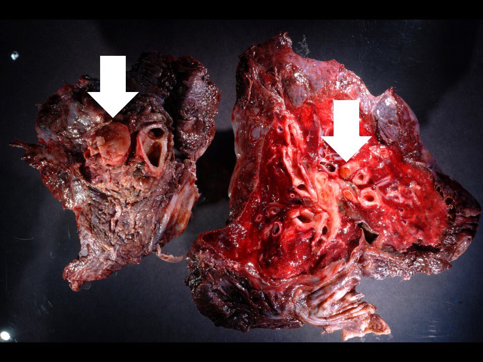 Intimal sarcoma of pulm artery = undifferentiated sarcoma within artery lumen. Often mistaken for pulmonary thrombus clinically #pulmpath