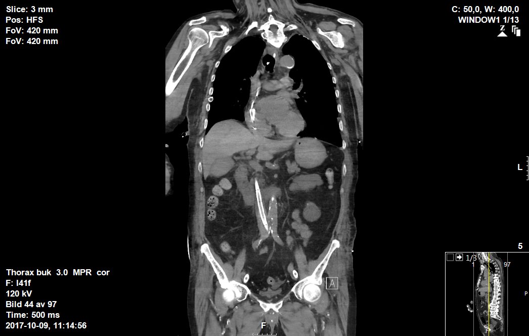 talherer's tweet photo. #echmo day 2 after #Trauma. #endovascular #rescucitation and part of the #EVTM. survivor. https://t.co/xsq2HldLEQ