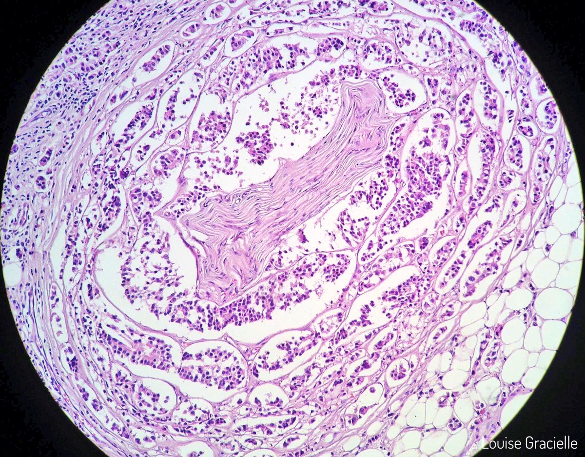 LouiseGracielle's tweet image. Breast carcinoma infiltrating a Pacinian corpuscle in a male patient. #breastcancer #pathology #paciniancorpuscle #breastpathology