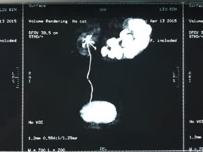 Principles of surgical treatment for hydronephrosis
tongshanclinic.com/treatment/arc_…
Send me your problem, I will give you professional guidance.