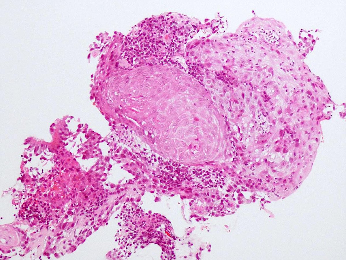 Patholwalker's tweet photo. Squamous cell carcinoma, lung, trans-bronchial lung biopsy (TBLB). HE stain. https://t.co/dRhvgJcczu
