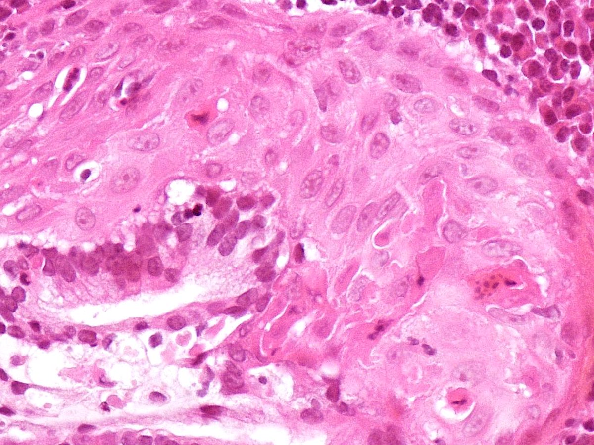 Patholwalker's tweet photo. Squamous cell carcinoma, lung, trans-bronchial lung biopsy (TBLB). HE stain. https://t.co/dRhvgJcczu