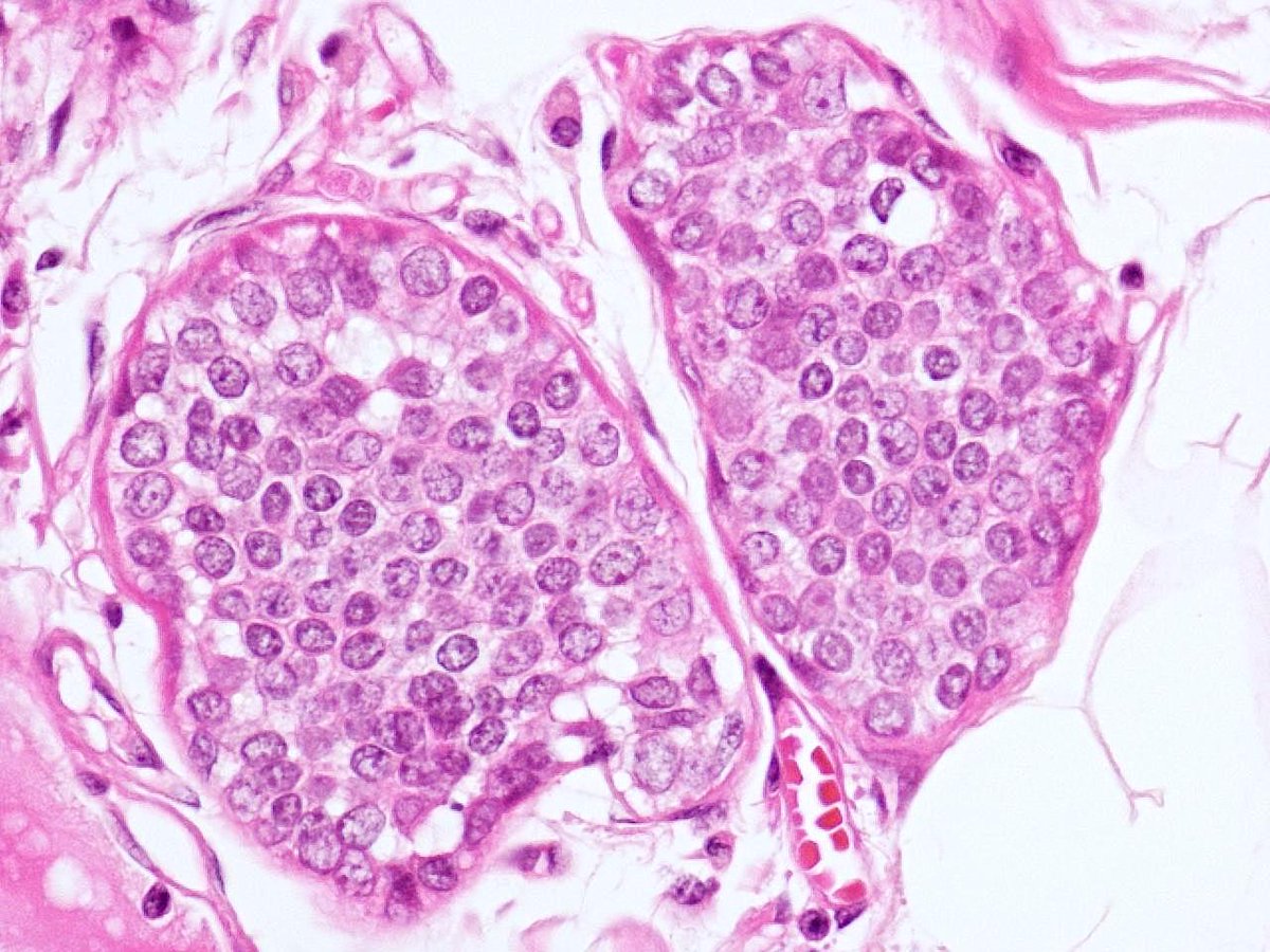 Patholwalker's tweet photo. Lobular carcinoma, invasive and in situ, breast resection. HE stain. https://t.co/Nh3aePGoDx