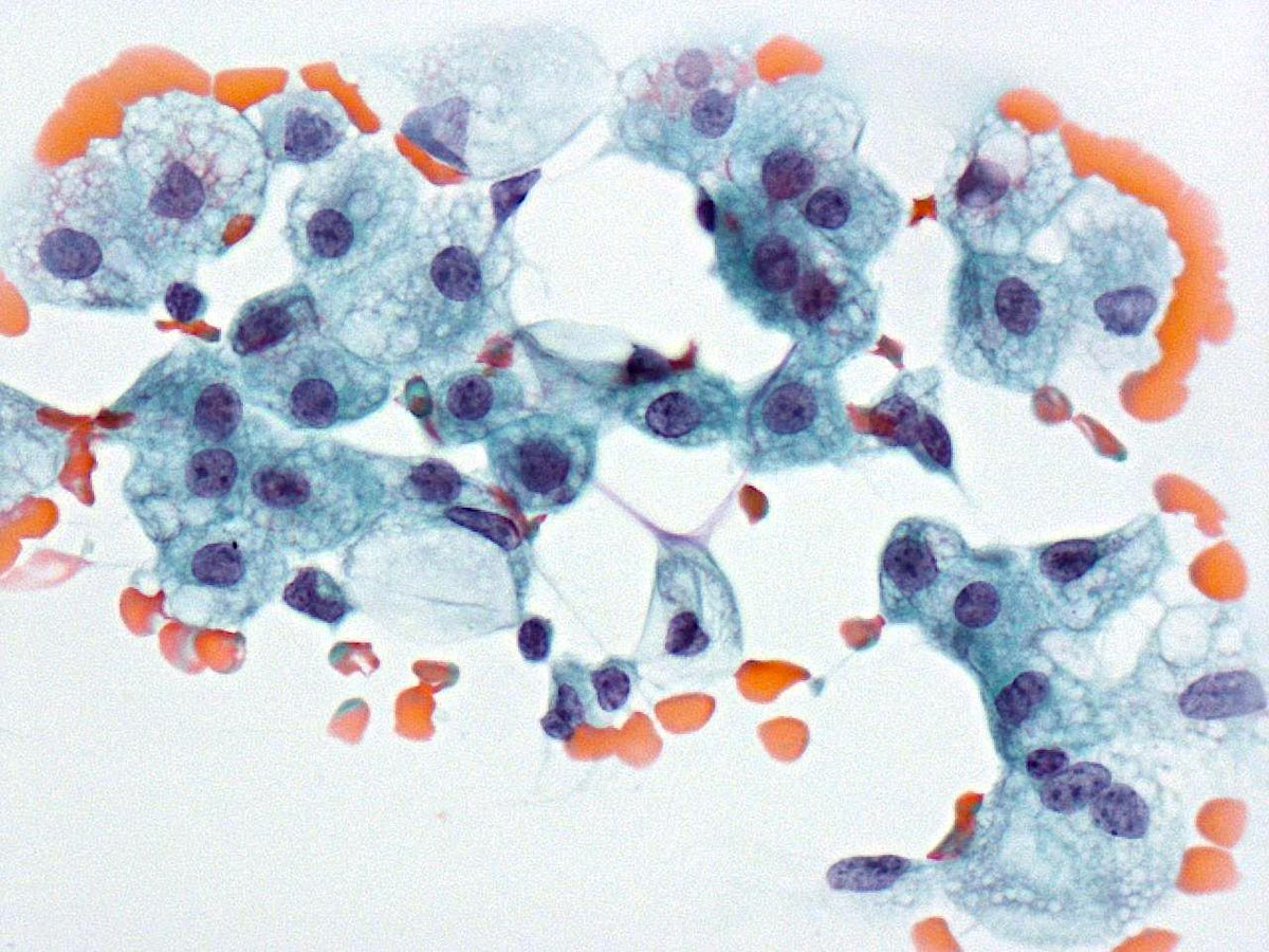 Patholwalker's tweet photo. Foamy macrophages seen in ascites. https://t.co/k0u7HvS39M