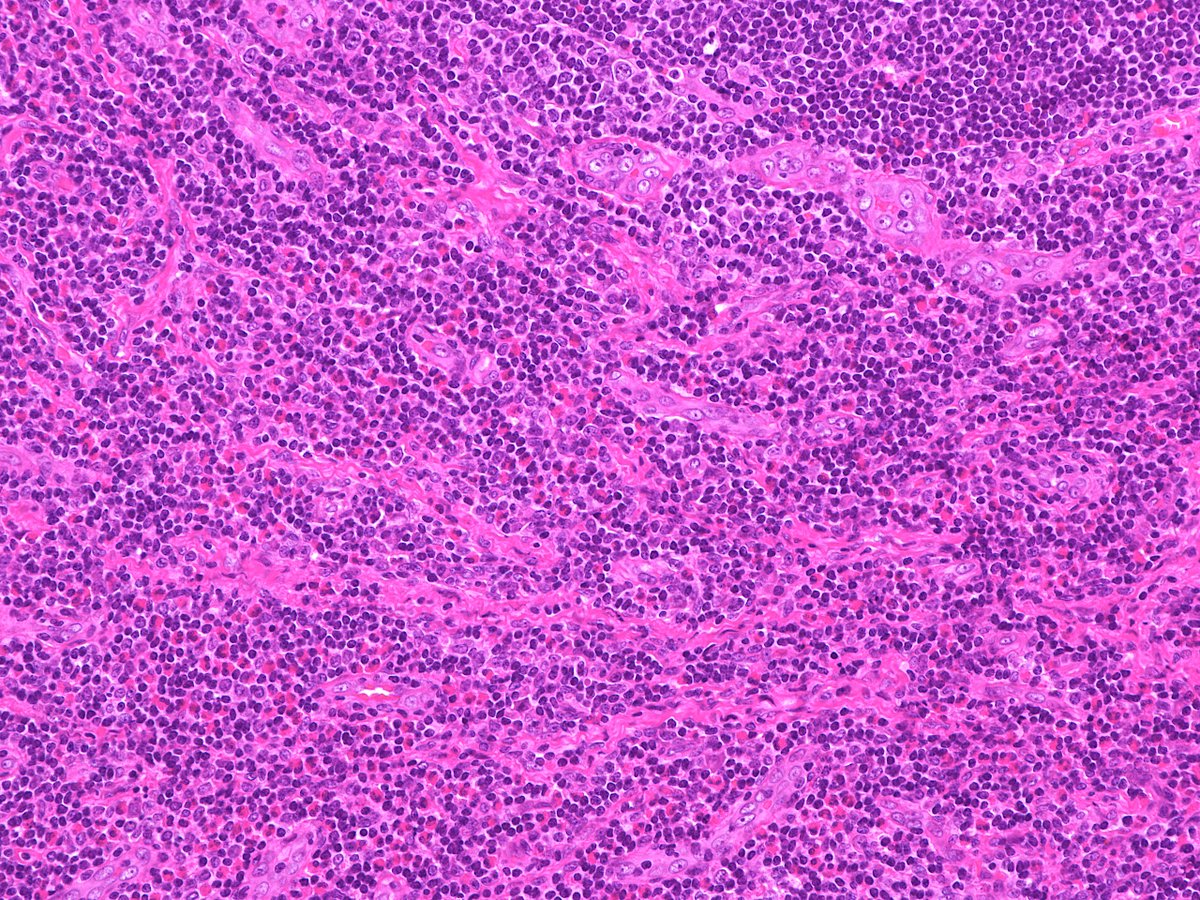 Patholwalker's tweet photo. Kimura's disease. Submandibular lymph node, excisional biopsy. HE stain. https://t.co/8uR9erZmOu