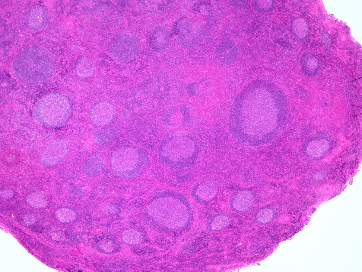 Patholwalker's tweet photo. Kimura's disease. Submandibular lymph node, excisional biopsy. HE stain. https://t.co/8uR9erZmOu