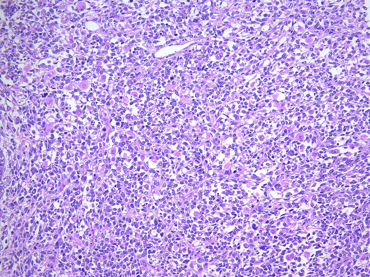 Patholwalker's tweet photo. Pleomorphic rhabdomyosarcoma. HE stain. https://t.co/FE6I0Vs8UE