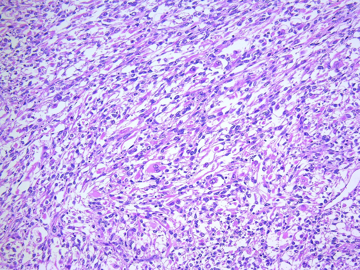 Patholwalker's tweet photo. Pleomorphic rhabdomyosarcoma. HE stain. https://t.co/FE6I0Vs8UE
