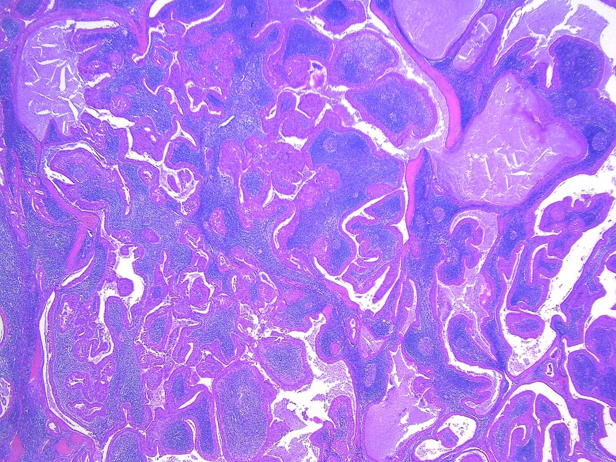 Patholwalker's tweet photo. Warthin’s tumor. HE and gross. https://t.co/rpIRTNK6J8