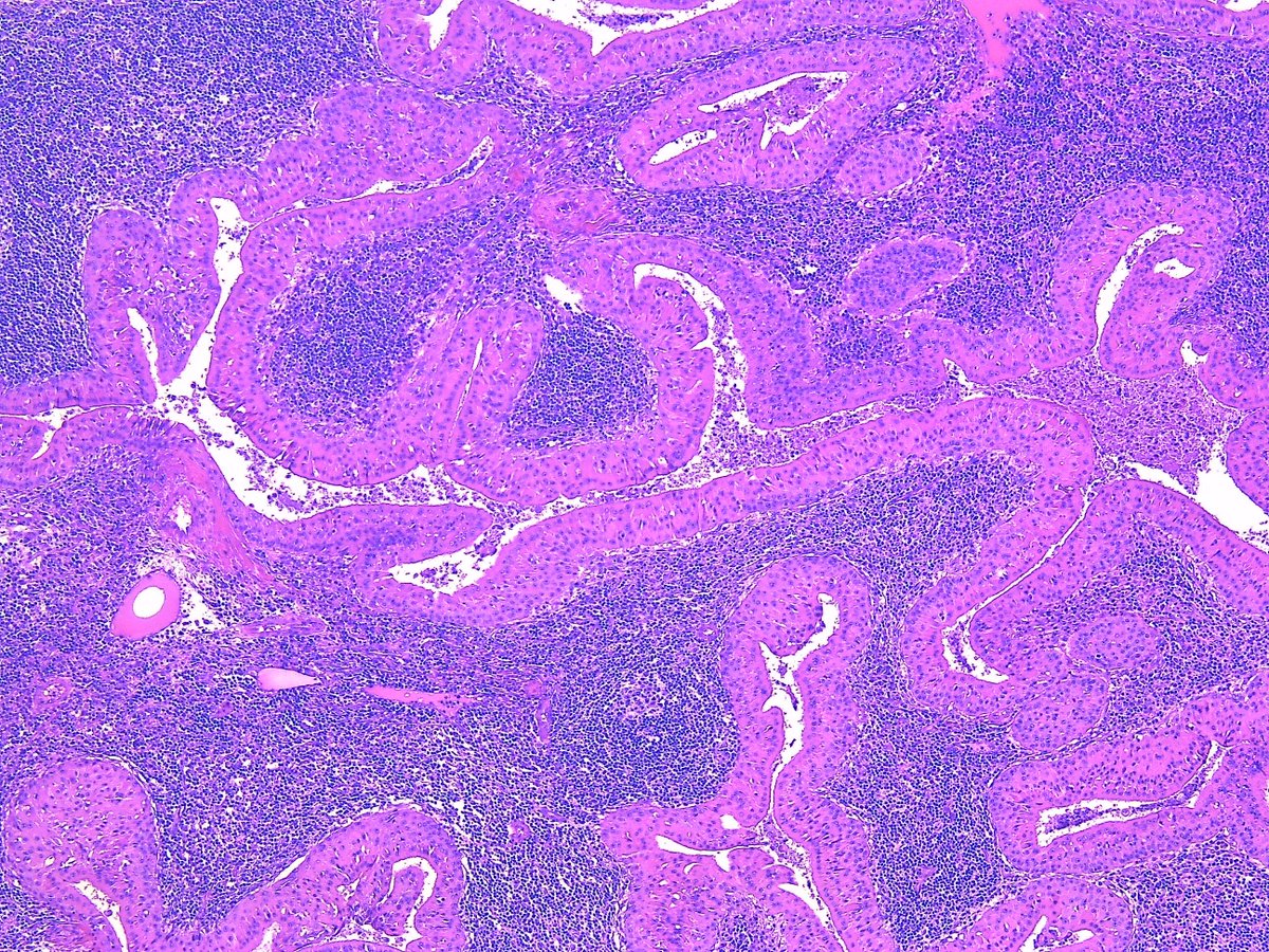Patholwalker's tweet photo. Warthin’s tumor. HE and gross. https://t.co/rpIRTNK6J8