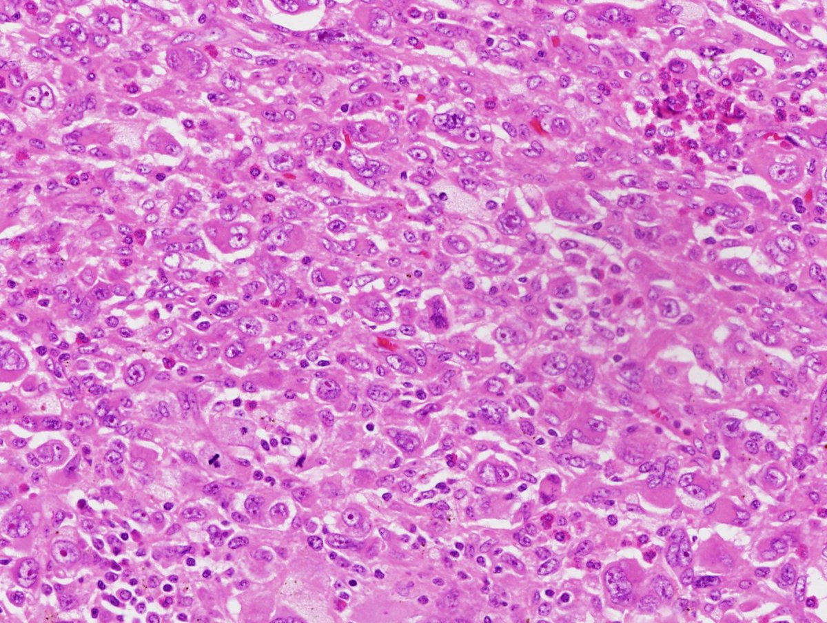 Anaplastic (undifferentiated) carcinoma, pancreas resection. HE stain.