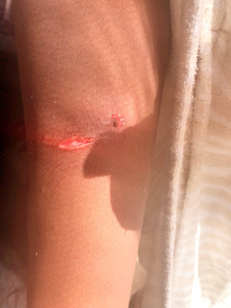 Que7LLB's tweet image. Glad to be home from @ushuaiaibiza horrific accident shower shattered while in the shower.Wonder if health and safety laws exist