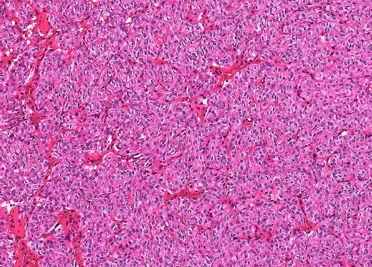Patholwalker's tweet photo. Hyalinizing trabecular tumor. Thyroid, thyroidectomy. HE stain. https://t.co/dkY6vZZl3P