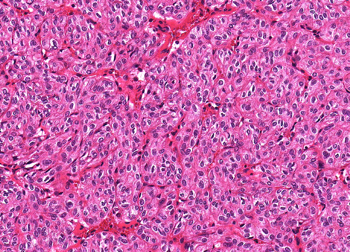 Patholwalker's tweet photo. Hyalinizing trabecular tumor. Thyroid, thyroidectomy. HE stain. https://t.co/dkY6vZZl3P