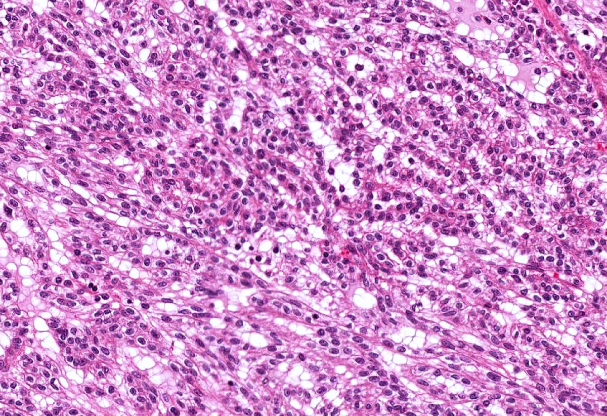 Mucinous tubular and spindle cell carcinoma. Kidney, nephrectomy. HE stain.