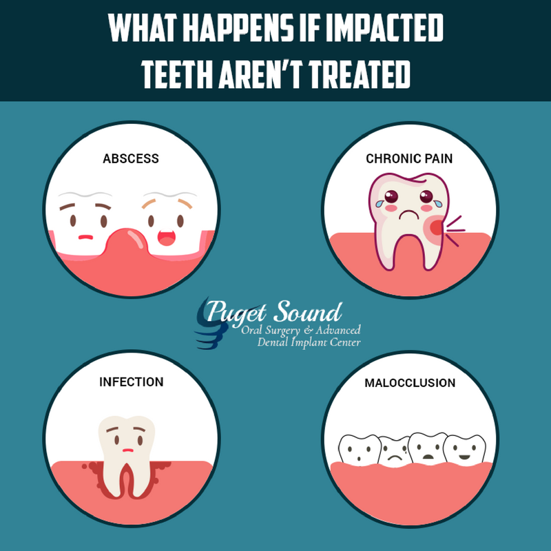 ps_oralsurgery's tweet photo. Don’t wait for #ImpactedTeeth to give you trouble. Get in touch with Puget Sound Oral Surgery today! #PSOMS #DentalCare https://t.co/LM2QOvevXQ