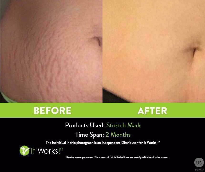 bestselfkaylee's tweet photo. Who wants their stretch marks GONE?! 😱I need 2 ✌️product testers ASAP! Get this $65 cream for only $39! 💚Message me or comment! ☺️📲 https://t.co/Fx2yPqWRmU