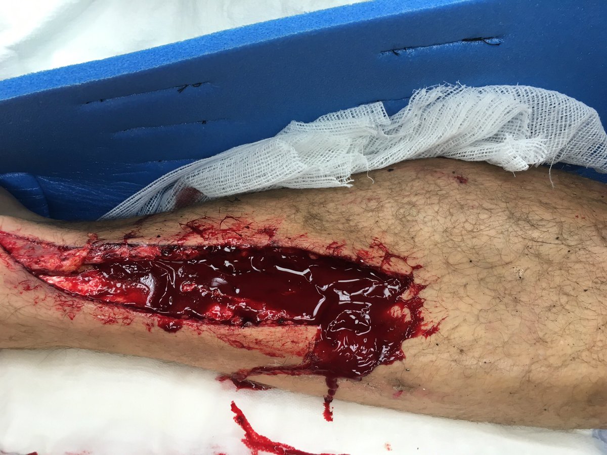 starykowicz's tweet photo. Mankind has no limits.  14 months, from dragged under a truck to @IRONMANtri #champion. https://t.co/PKkA8nz3yk