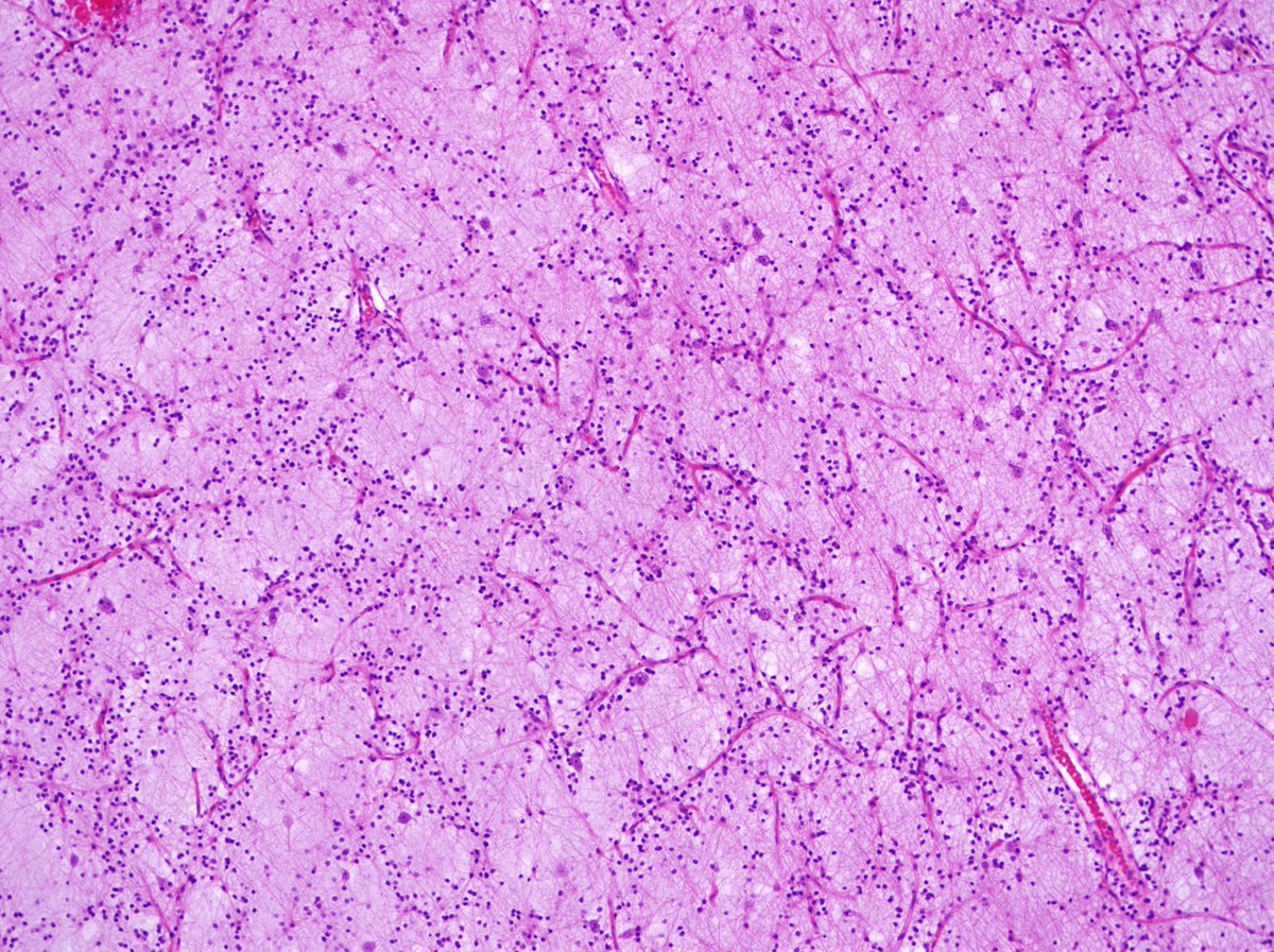 Pathology Walker@Auto Tweet Bot tweet media