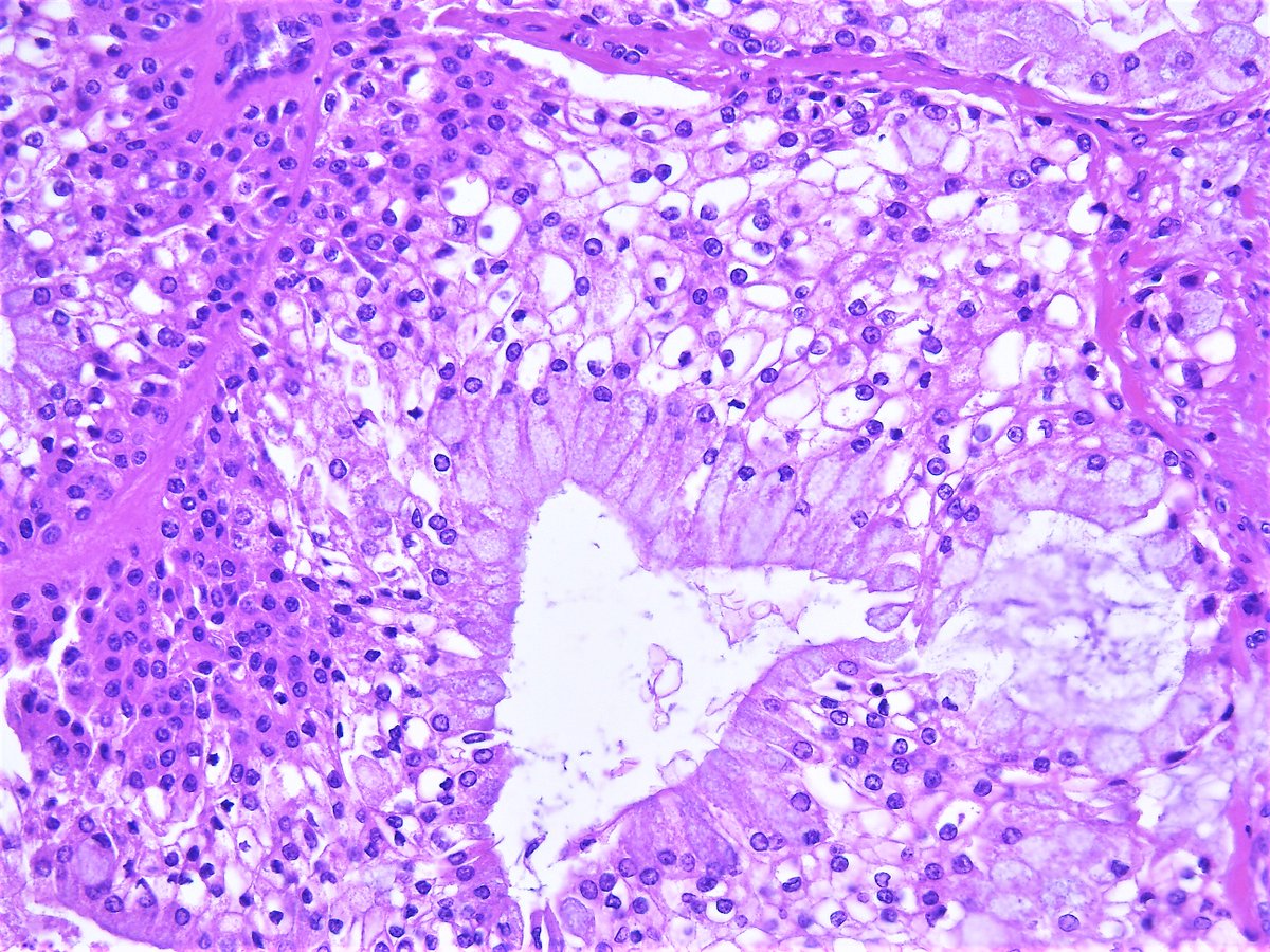 Mucoepidermoid carcinoma, low grade. Parotid gland, parotidectomy. HE stain.