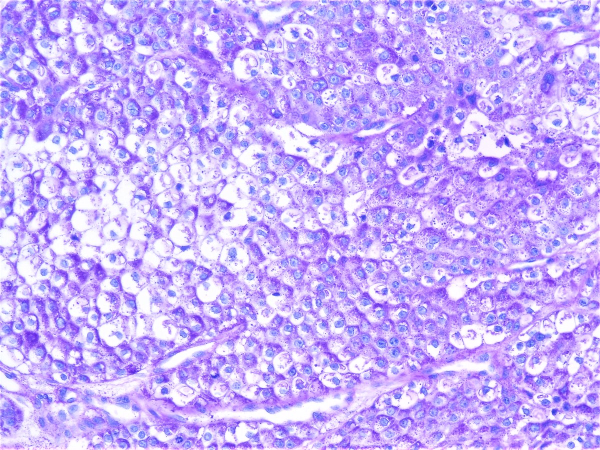 Central mucoepidermoid carcinoma of the Maxilla. Maxillary bone, resection. HE and PAS stain.