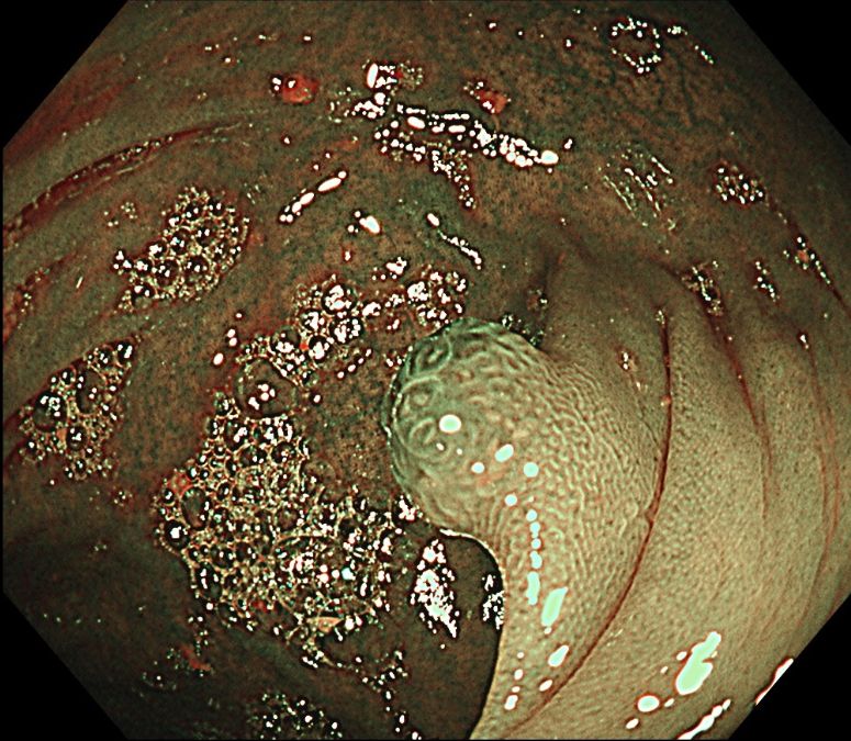 Juvenile polyp. Colon, polypectomy. HE and Endoscopic images (white light and NBI{ }).