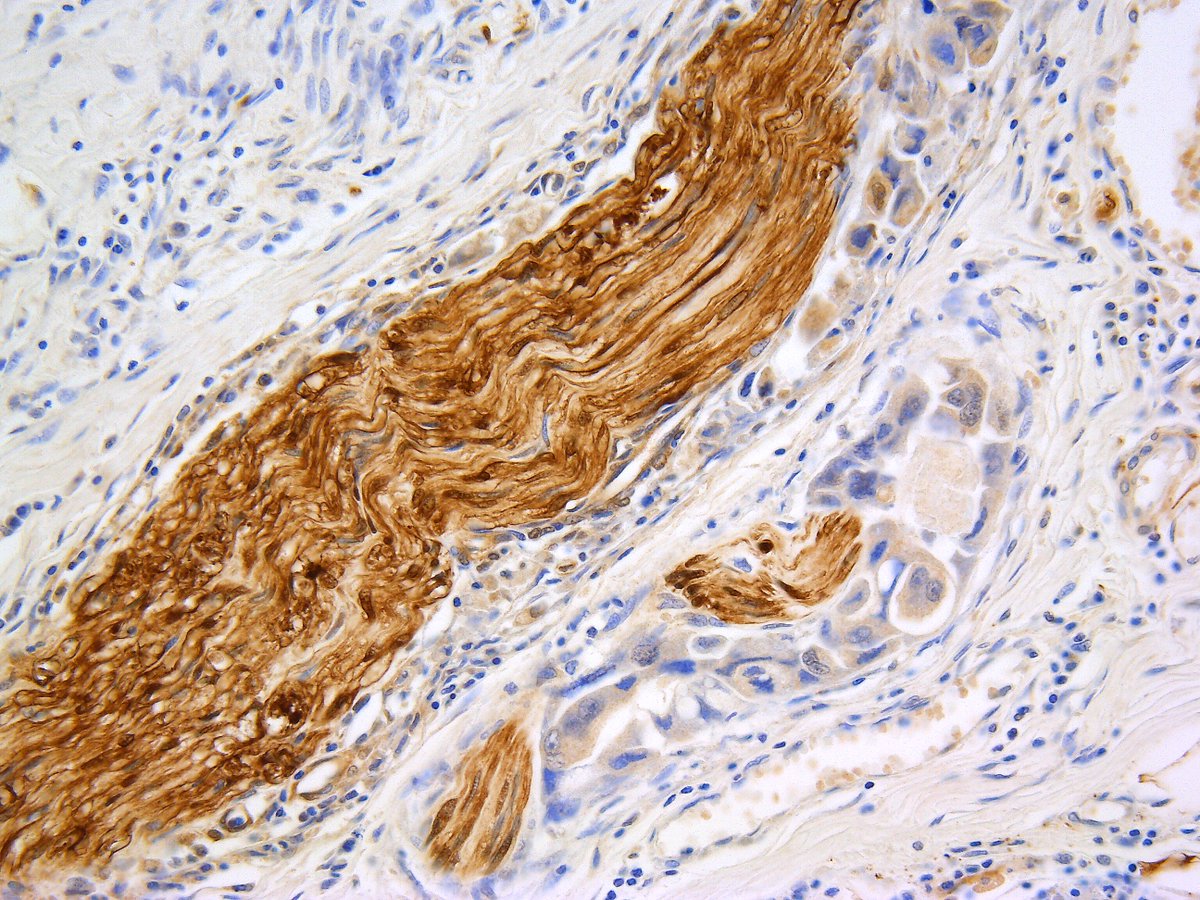 Perineural invasion (salivary duct carcinoma). HE and S-100P