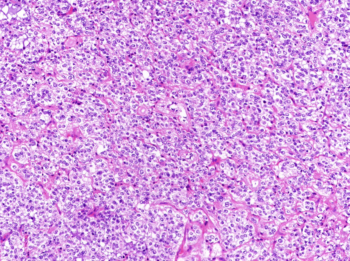 Patholwalker's tweet image. Oligodendroglioma, NOS, WHO grade II. Cerebrum, resection. HE stain.