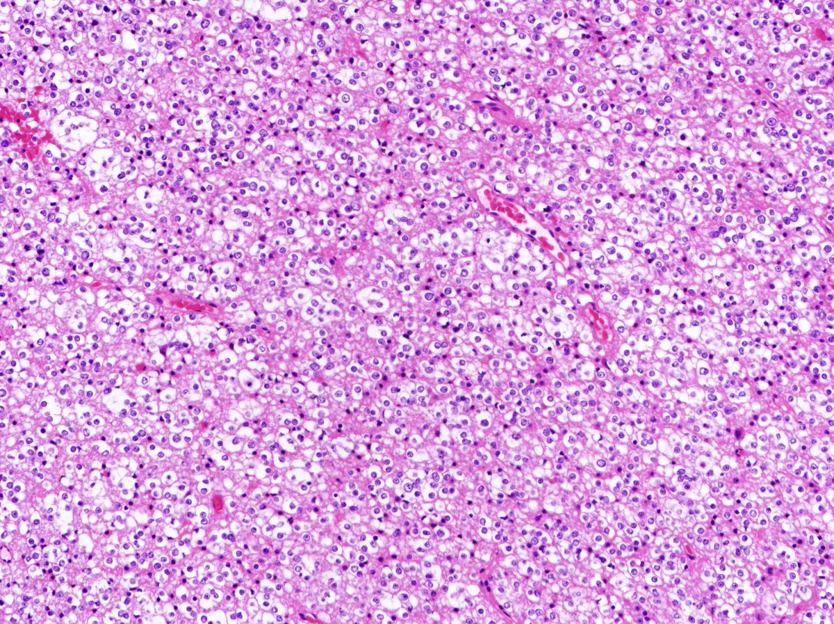 Patholwalker's tweet image. Oligodendroglioma, NOS, WHO grade II. Cerebrum, resection. HE stain.