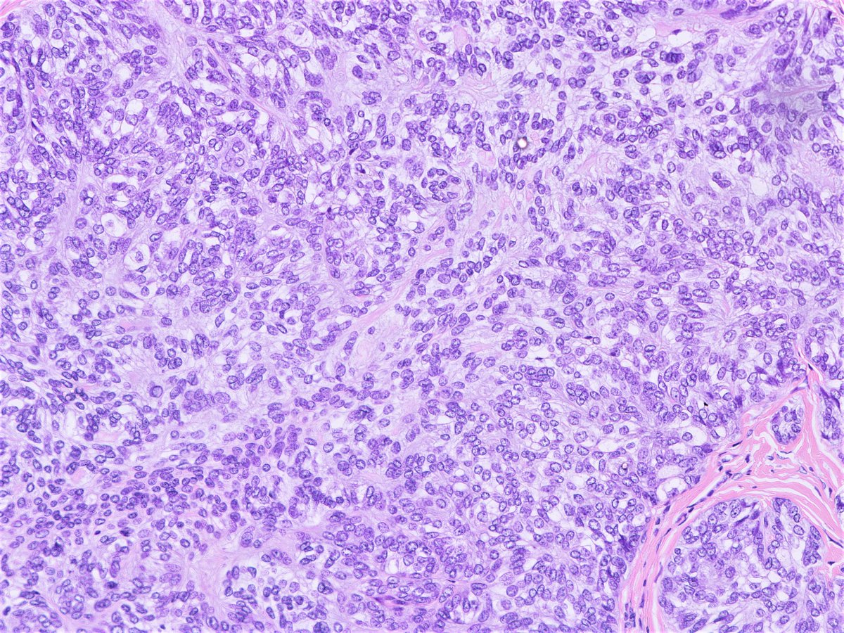 Patholwalker's tweet photo. Sebaceoma. Skin, resection. HE stain. https://t.co/z27Auq0Ysy