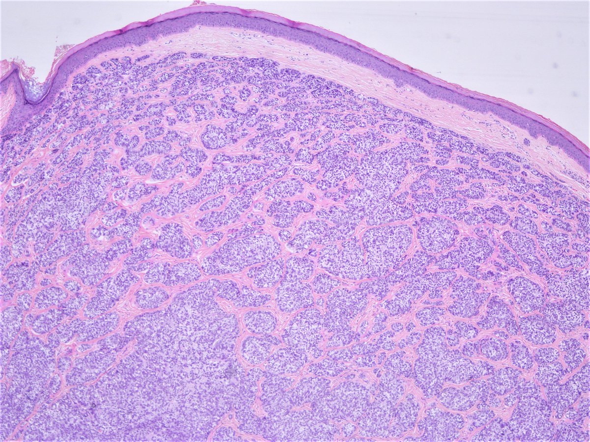 Patholwalker's tweet photo. Sebaceoma. Skin, resection. HE stain. https://t.co/z27Auq0Ysy