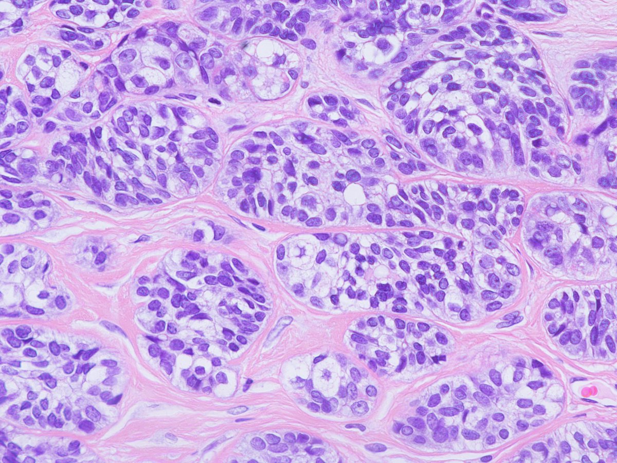 Patholwalker's tweet photo. Sebaceoma. Skin, resection. HE stain. https://t.co/z27Auq0Ysy