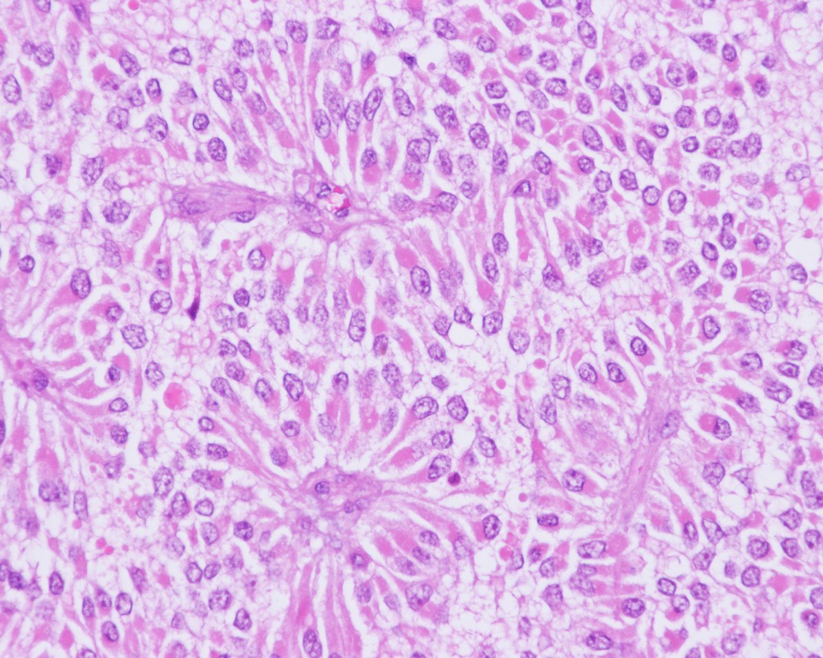 Patholwalker's tweet photo. Solid pseudopapillary neoplasm. Pancreas, resection. HE stain. https://t.co/zLd6nnFKvr