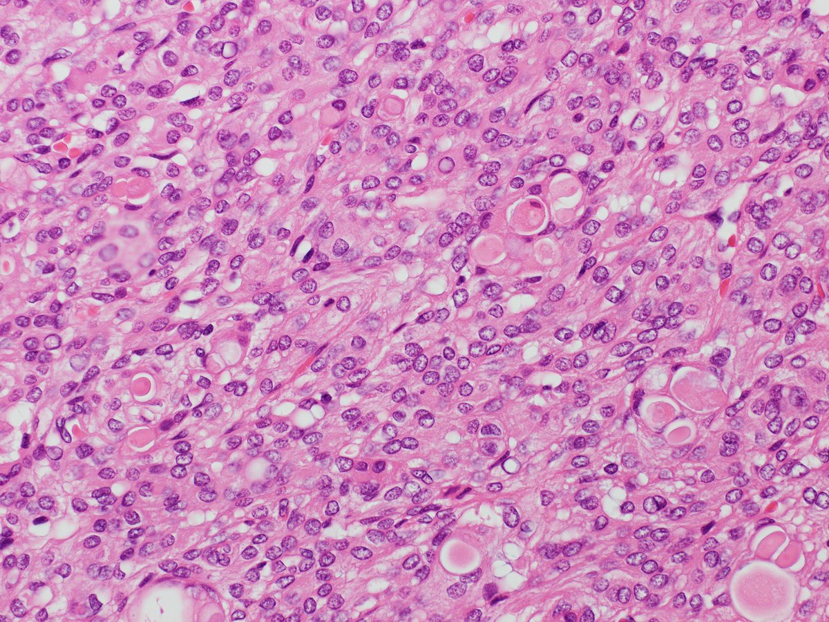 Patholwalker's tweet photo. Secretory meningioma, WHO grade I. https://t.co/F5LKVAxfx3