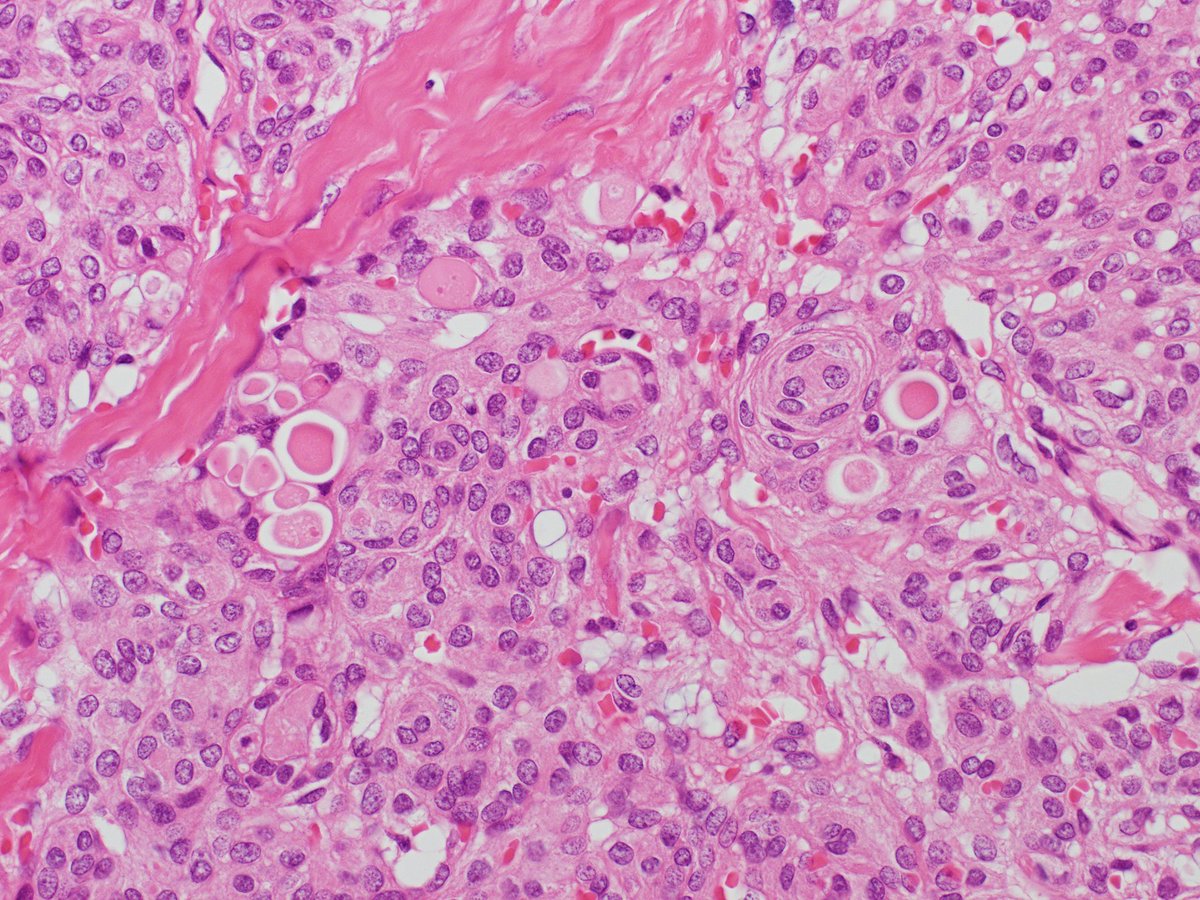 Patholwalker's tweet photo. Secretory meningioma, WHO grade I. https://t.co/F5LKVAxfx3