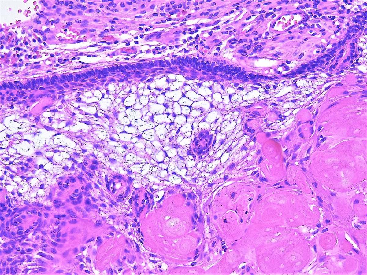 Patholwalker's tweet photo. Craniopharyngioma, adamantinomatous type, WHO grade I. https://t.co/fgrlefXDYm
