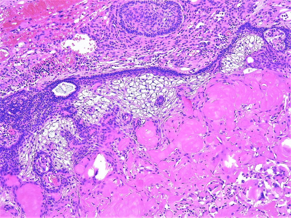 Patholwalker's tweet photo. Craniopharyngioma, adamantinomatous type, WHO grade I. https://t.co/fgrlefXDYm