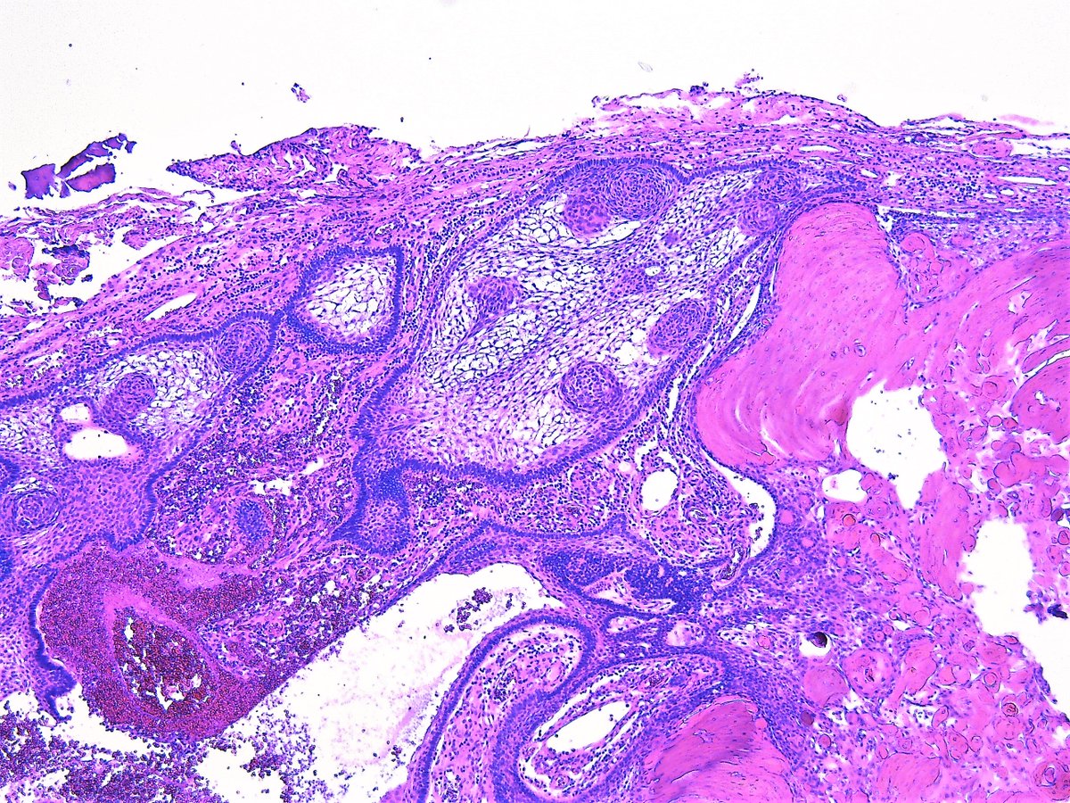 Patholwalker's tweet photo. Craniopharyngioma, adamantinomatous type, WHO grade I. https://t.co/fgrlefXDYm