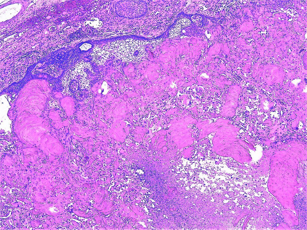 Patholwalker's tweet photo. Craniopharyngioma, adamantinomatous type, WHO grade I. https://t.co/fgrlefXDYm