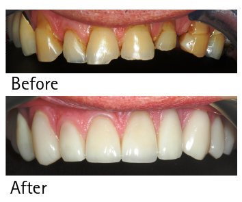 StoneRockKent's tweet photo. A Smile Changing Veneer Case
https://t.co/Lj3EY17Ite https://t.co/U0qaEwlpgh